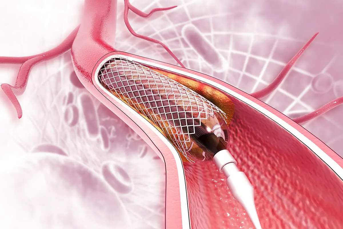 Balon ve Stent