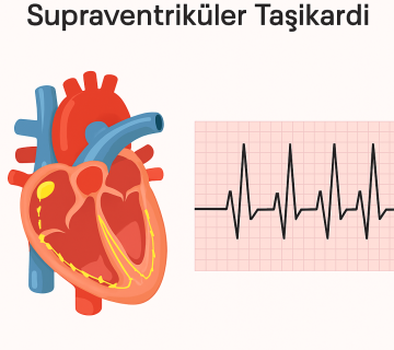 Supraventriküler Taşikardi (SVT)